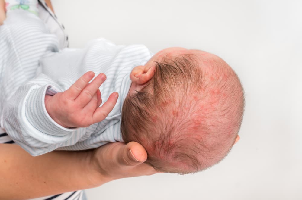 Newborn baby with a skin rash, possibly an allergic reaction after birth as the body works to detoxify and adjust to the new environment.